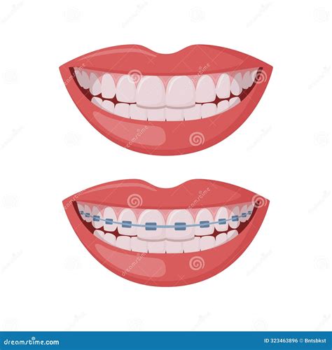 Braces Corrective Orthodontics, Smiling Female Mouth with Healthy Teeth