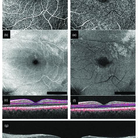 Structural Optical Coherence Tomography Oct And Oct Angiography