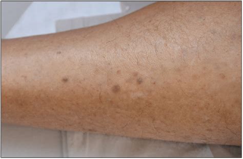 Clinical Manifestation Of The Patient Multiple Brown To Gray Colored Download Scientific