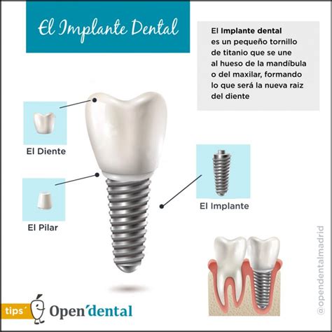 Ventajas De Los Implantes Dentales Archivos Clinica Bustillo Hot Sex