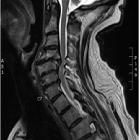 Pre Op Sagittal Magnetic Resonance Image Mri Cervical Spine