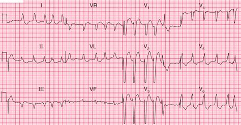 Hypokalemia ECG Changes With Examples Manual Of Medicine