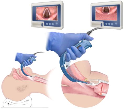 Figure 4 From Tips And Troubleshooting For Use Of The Glidescope Video Laryngoscope For