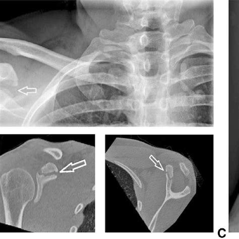 A Eyres Classification Of Coracoid Process Fractures Type I Is A Tip Download Scientific