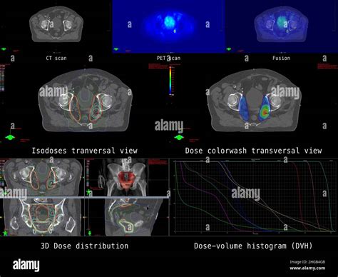 Overview Of Modern Radiation Planning For Cancer Therapy In Prostate Cancer With Pelvic Lymph