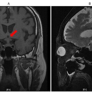 Brain MRI on June 2. A: Coronal section. B: Sagittal section. Note the ...