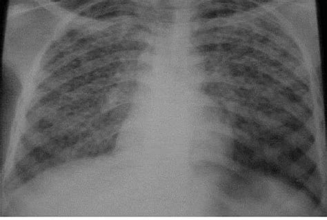 Miliary Tuberculosis Chest X Ray Showing Millet Like Shadows In A