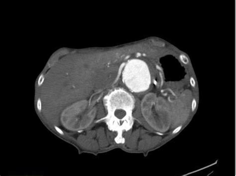 GI And GU Radiology Flashcards Quizlet