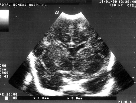 Normal Neonatal Head Ultrasound