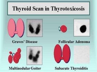 Nuclear Medicine - Thyroid - Procedure/Scan