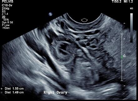 Ruptured Tubal Ectopic Pregnancy Radiology Case Radiopaedia Org