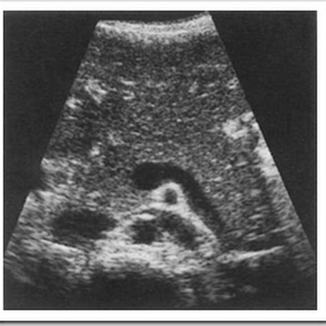 Normal ultrasound images of pancreas pediatric - Radiology Imaging