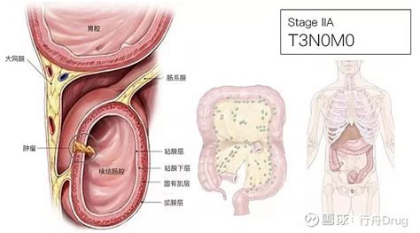 一文了解：结直肠癌tnm分期 点击上方的 行舟drug 添加关注 肿瘤分期是临床诊断和治疗的依据，目前常用的方法为tnm分期。第八版的更新再次