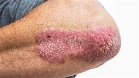 Psoriasis Elbow