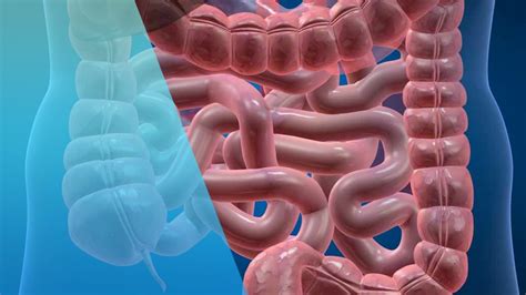 Enfermedad de crohn síntomas Prevención y Tratamiento 2020