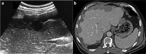 Hepatobiliary And Pancreatic SubGlisson S Capsule Hepatic Multiple