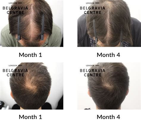 Hair Loss Success Story This Is One Of The Very Few Hair Growth