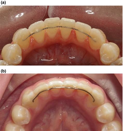 Retention And Relapse In Clinical Practice Littlewood 2017 Australian Dental Journal