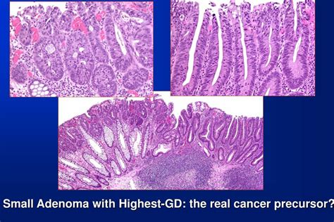 Ppt The Adenoma Carcinoma Sequence In The Colon Powerpoint