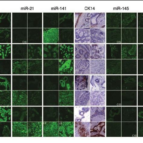 Altered Expression Of Mirnas In Different Tumor Subtypes Of Breast