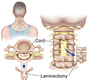 Cervical Laminectomy -Redlands, Loma Linda, Highland | Bones and Spine ...