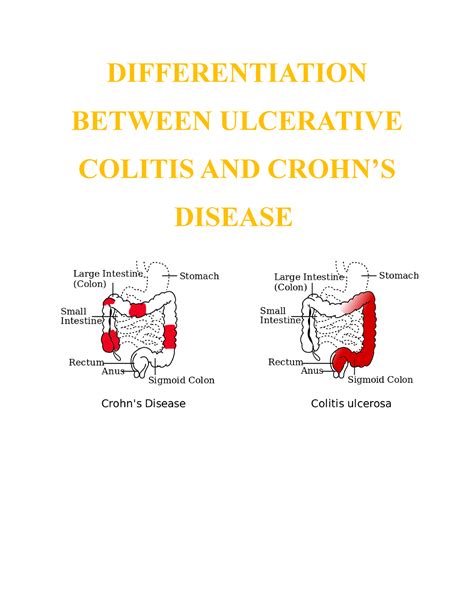 Comparison Of Ulcerative Colitis And Crohn S Disease Differentiation Between Ulcerative