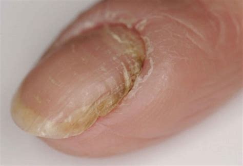 Hangnail & infected hangnail causes, symptoms, diagnosis & treatment