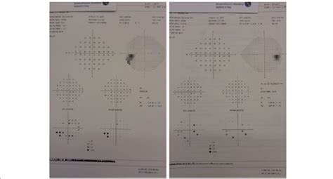 24 2 Humphrey Visual Fields Of The Right And Left Eye Download