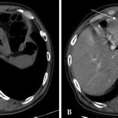 Case 2 Radiofrequency Ablation Of Hepatic Metastases From Gastric