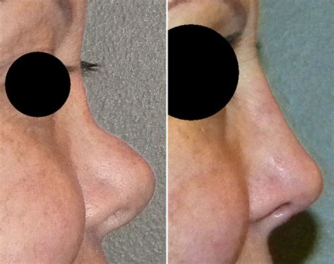 Rib Graft Rhinoplasty Result After Fracture Side View Dr Barry Eppley