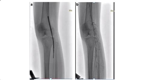 A Multiple Plain Old Balloon Angioplasty Dilatations B Flow After