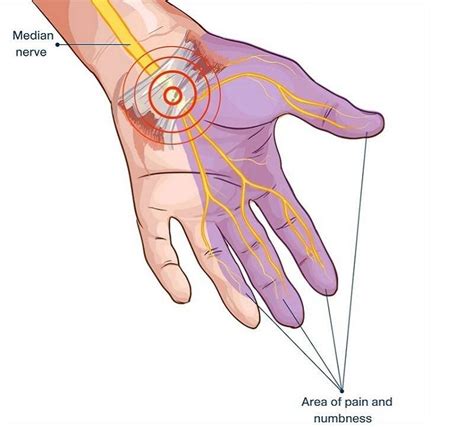 Peripheral Nerve Surgery SBF Sports Hand Centre