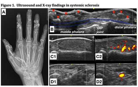 Ultrasound Detection of Calcinosis and Correlation with Ulnar Artery Occlusion in Patients with ...