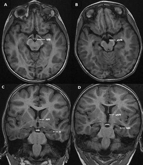 Axial T1 3d Spgr Image Showing Mammillary Body Mb In Control And