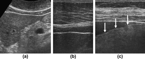 Non Invasive Evaluation Of Liver Cirrhosis Using Ultrasound Clinical Radiology