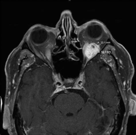 Surgical Neurology International