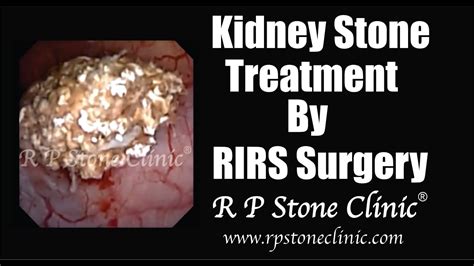 Kidney Stone Treatment By Rirs Surgery At R P Stone Clinic Youtube