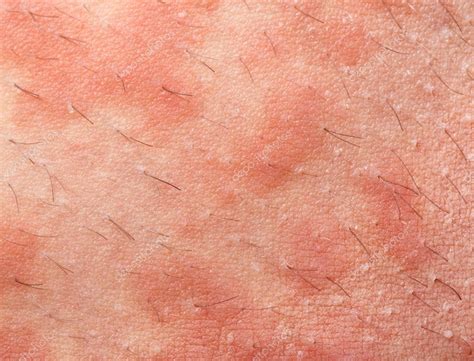 Atopische Dermatitis Eczeem — Stockfoto © Antoniogravante 67251371