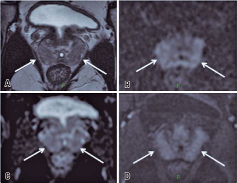 Scielo Brasil Prostate Imaging Features On Magnetic Resonance