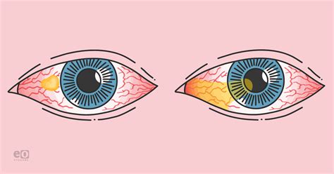 Pterygium Vs Pinguecula What To Know And How To Treat