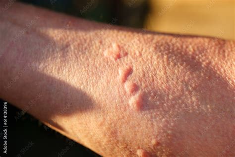 The Skin S Reaction To Nettle Is Urticaria Red Severely Itchy Rashes