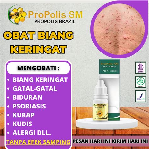 Jual Obat Biang Keringat Obat Miliaria Rubra Obat Gatal Biang