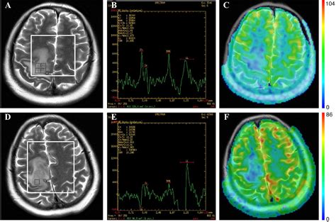 Figure From Radionecrosis Mimicking Pseudoprogression In A Patient