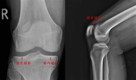 膝蓋退化手術別害怕 微創半套人工膝關節置換向疼痛說掰掰