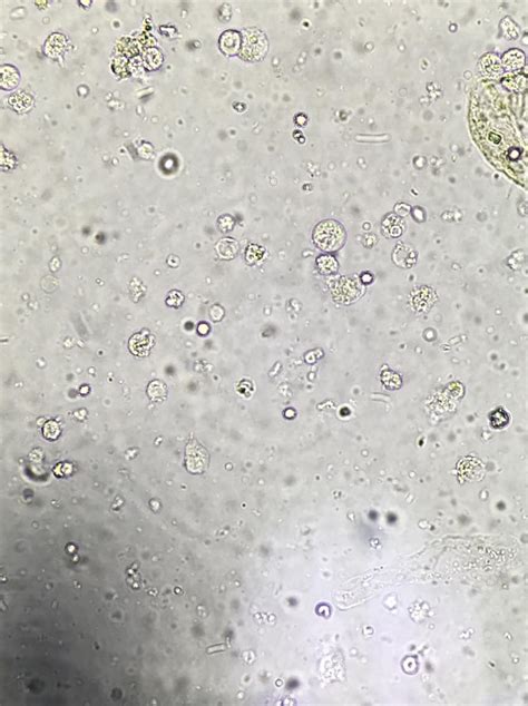 Entamoeba Histolytica Stool