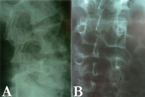 Lateral A And Antero Posterior B X Ray Studies Of The Spine Showing