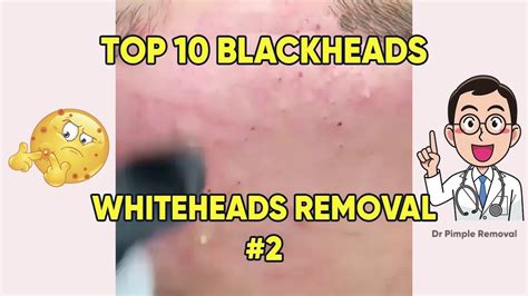 Top 10 Pimple Popper Removal Blackheads Whiteheads 2019 2 Youtube