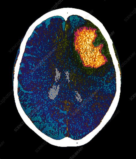 Brain Haemorrhage Ct Scan Stock Image M1360282 Science Photo