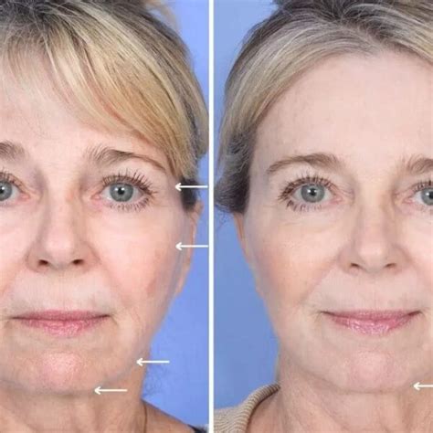 Sculptra Before And After Transforming Your Appearance With Long Lasting Results Must Read