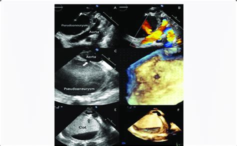 A F 2D Transthoracic Echocardiography A And B Suprasternal View